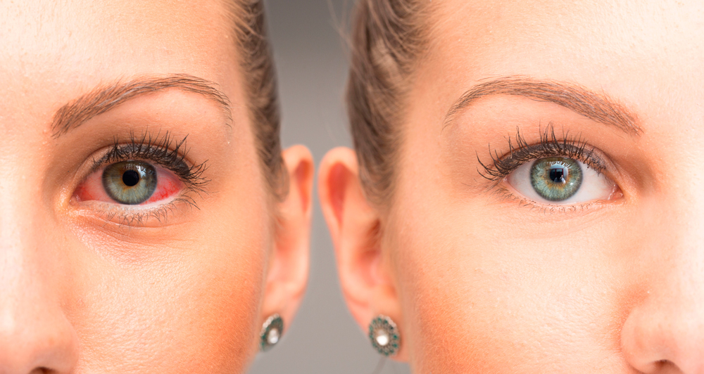 uveitis