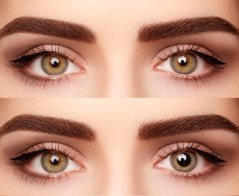 ¿Qué es la anisocoria? Causas y Tratamiento