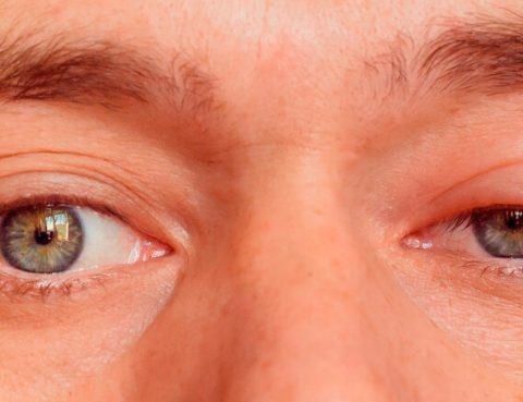 ptosis palpebral