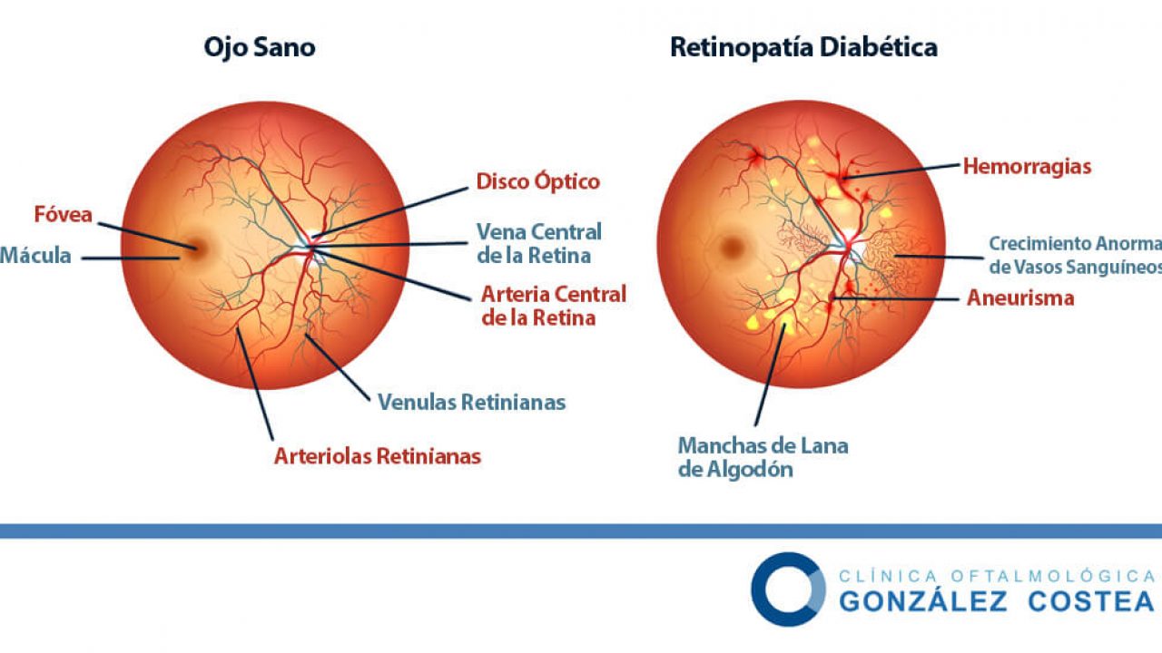 retinopatia diabetica clinica