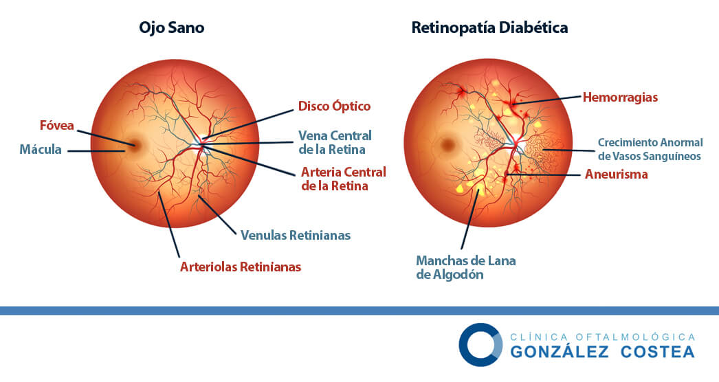 retinopatia diabetica proliferativa