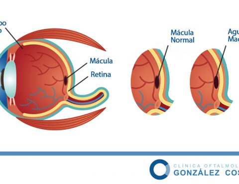 agujero macular