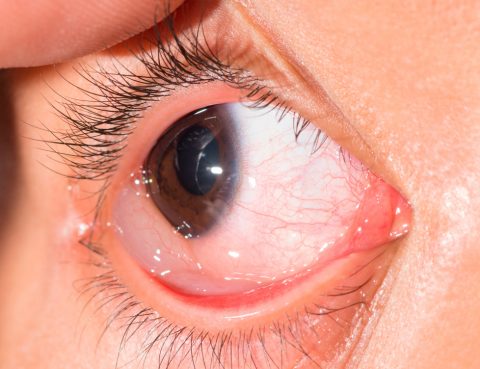 quemosis conjuntival