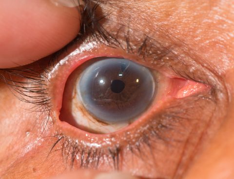iridotomia tratamiento glaucoma