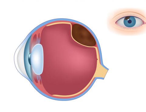 melanoma-ocular
