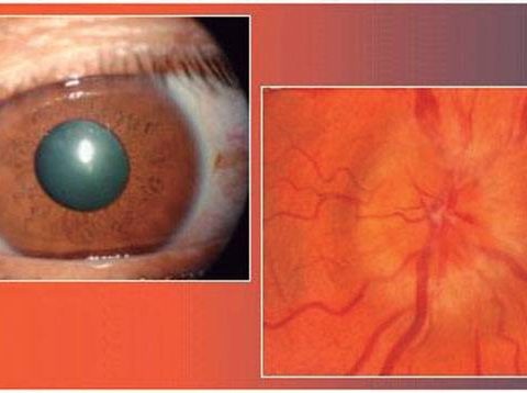 neuritis óptica