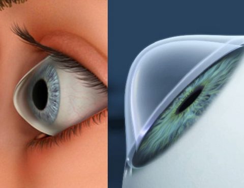 ectasia corneal