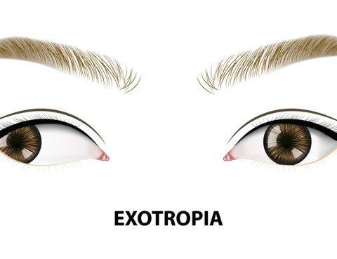 exotropía