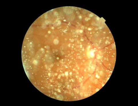hialosis asteroide