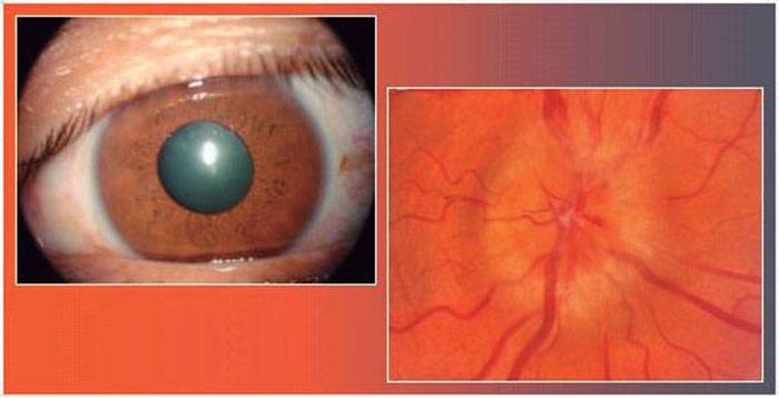 neuritis óptica