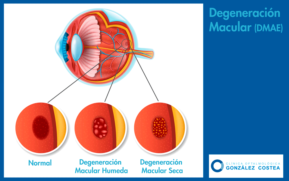 degeneración macular