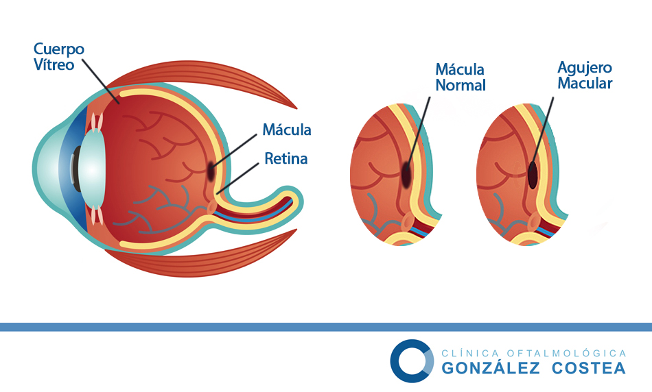 agujero macular