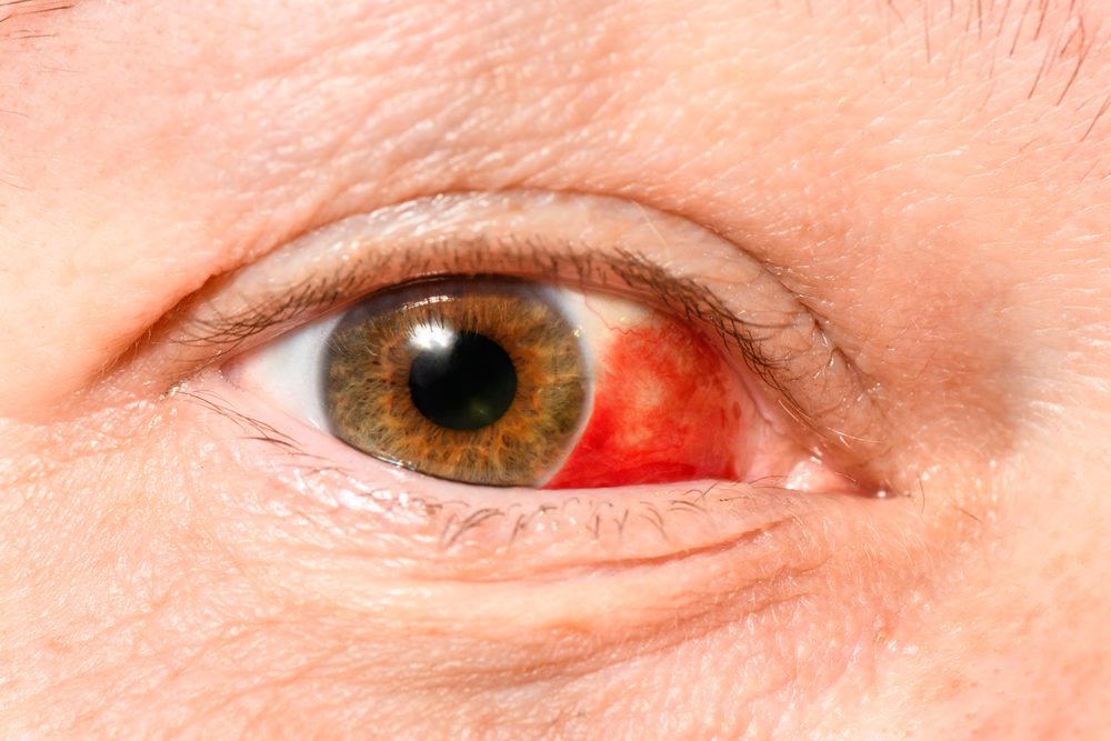 derrame ocular|hemorragia subconjuntival