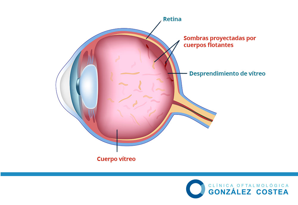 desprendimiento de vítreo