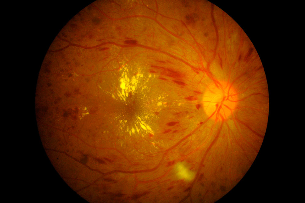 edema-macular