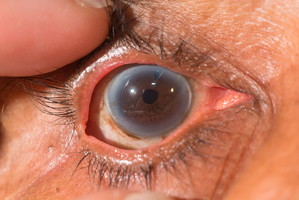 iridotomia tratamiento glaucoma