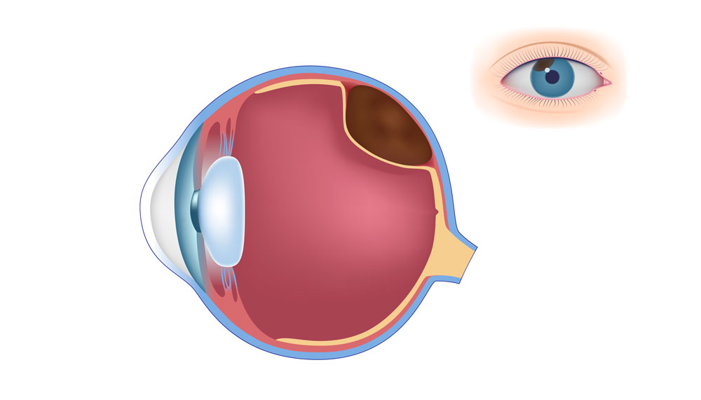 melanoma-ocular