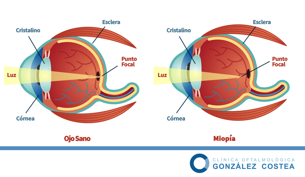 miopía magna