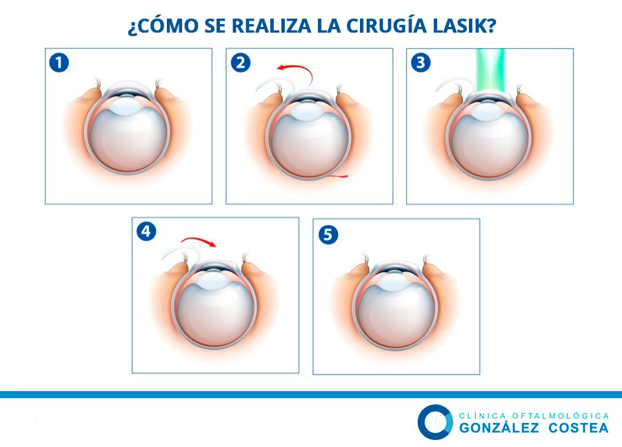 procedimiento técnica lasik