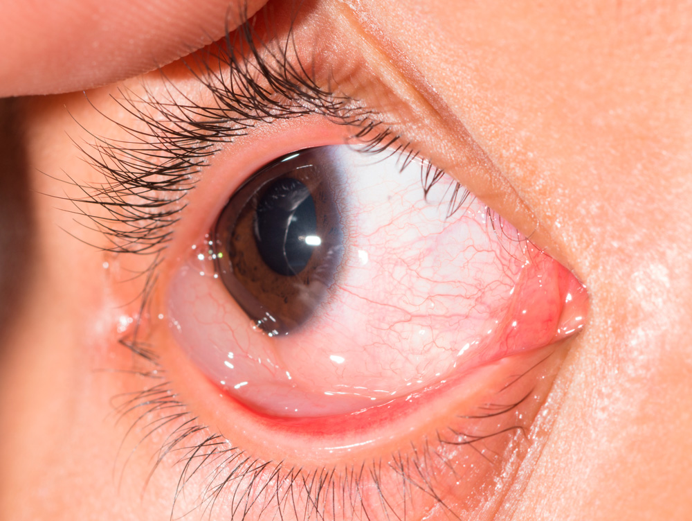 quemosis conjuntival