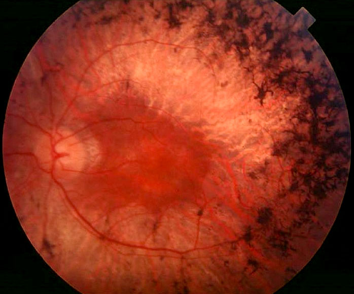 retinosis pigmentaria