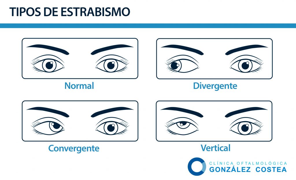 tipos de estrabismo