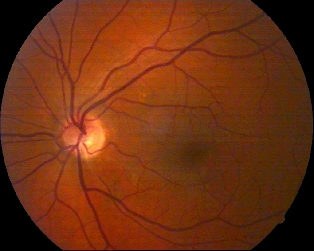trombosis ocular