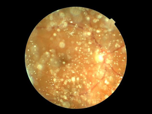 hialosis asteroide