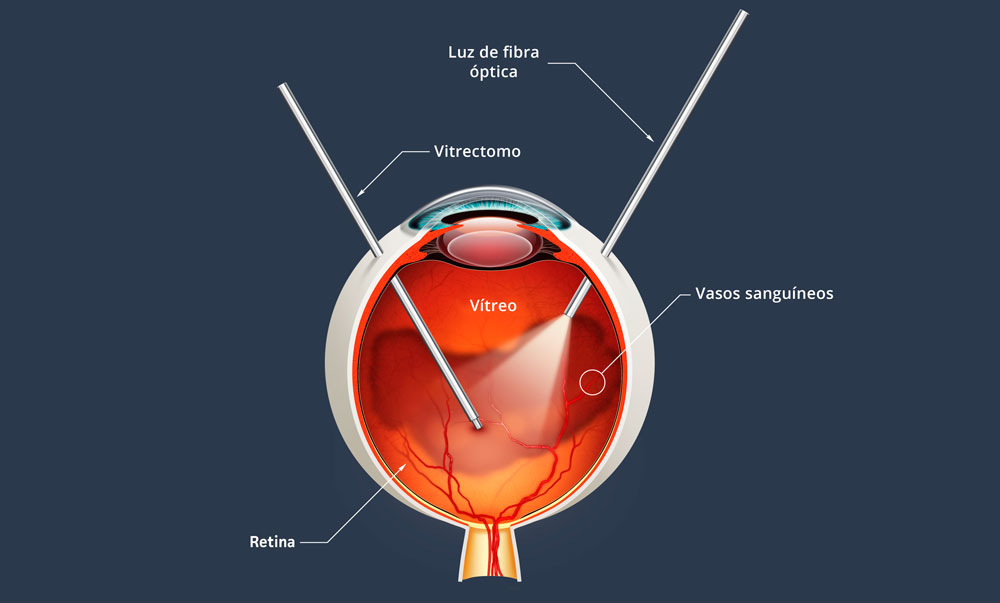 vitrectomía